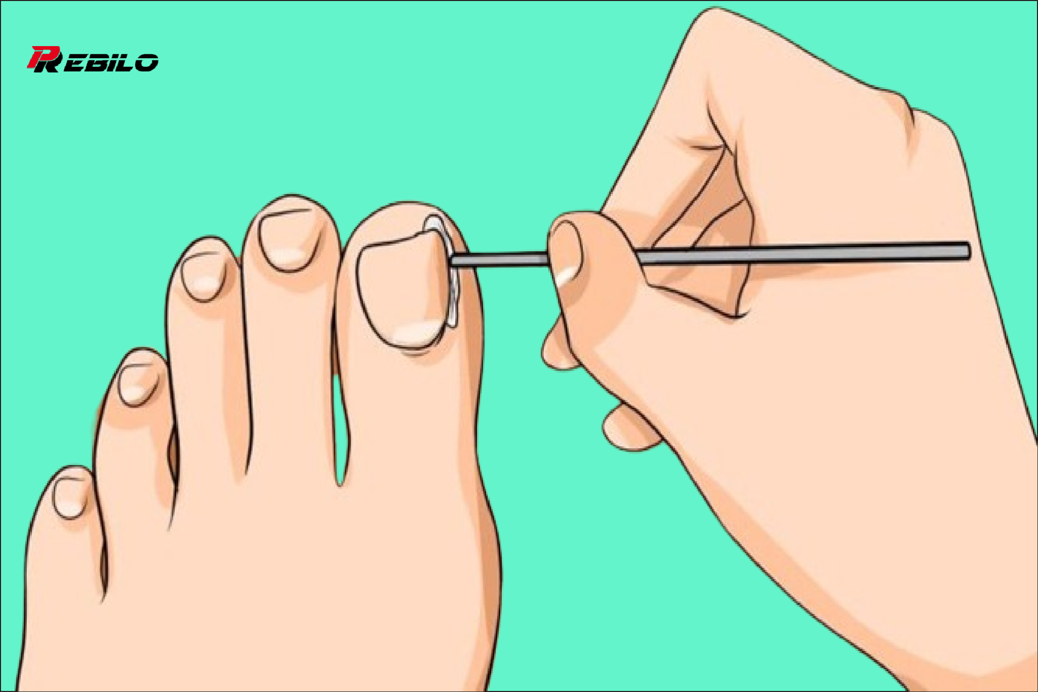 How To Get Rid Of Ingrown Toenail