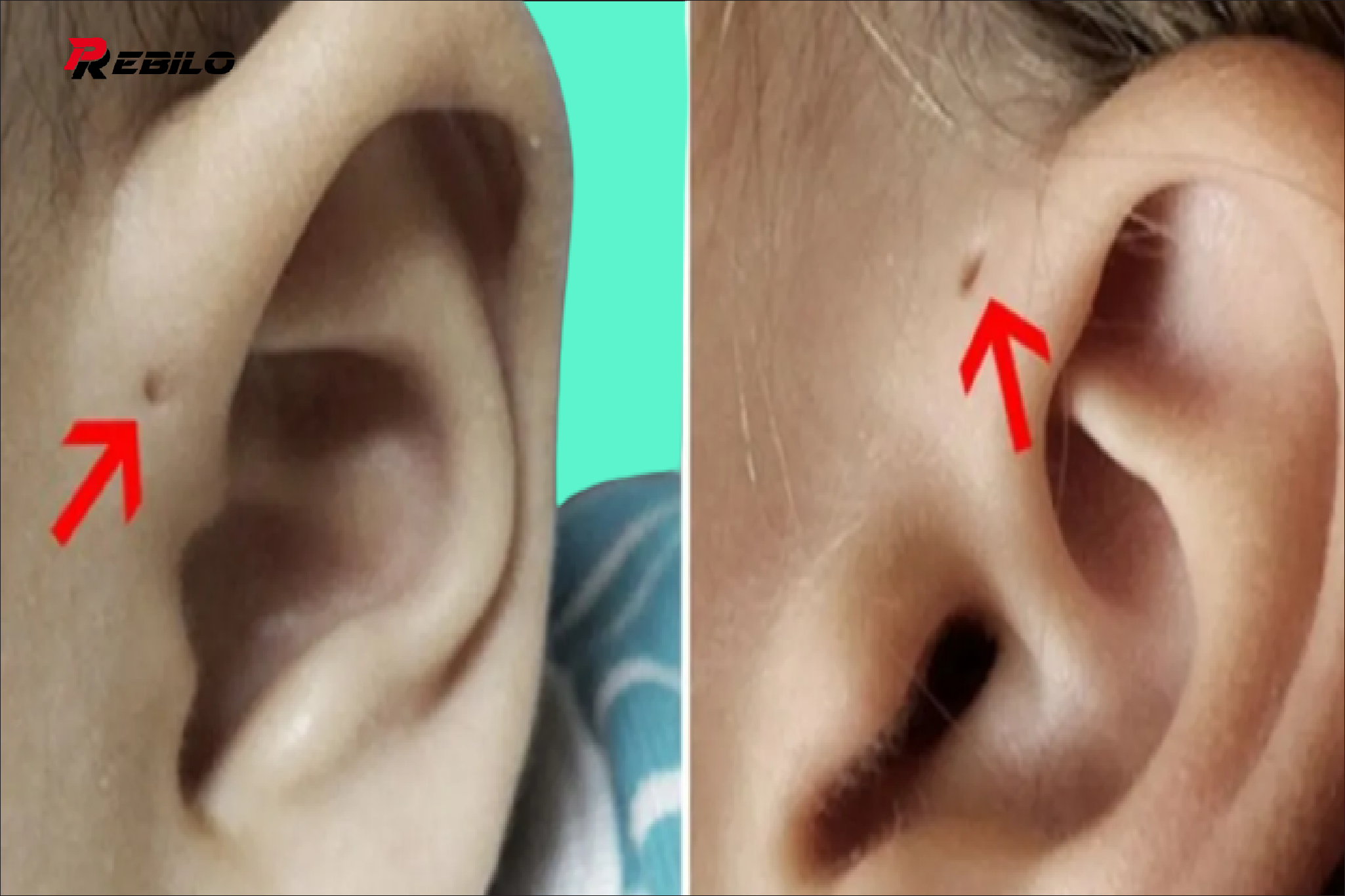 If you have a small hole above your ear, here’s what it means