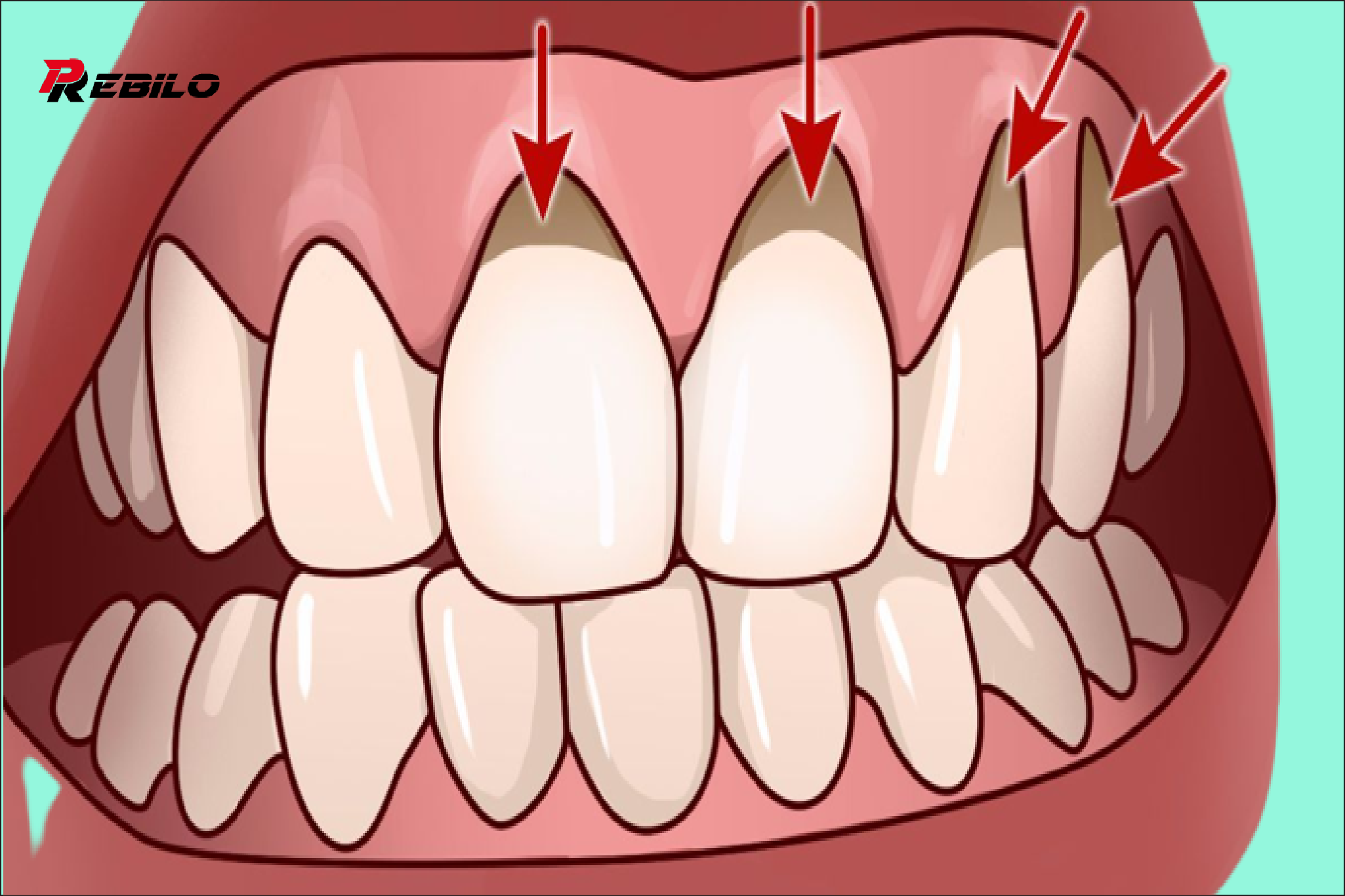 10 easy ways to treat receding gums naturally!