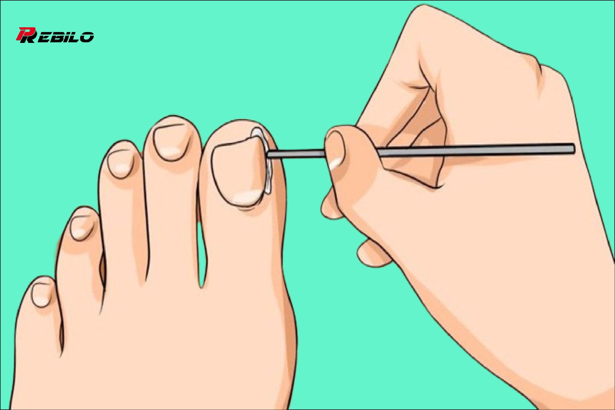 How to get rid of ingrown toenail